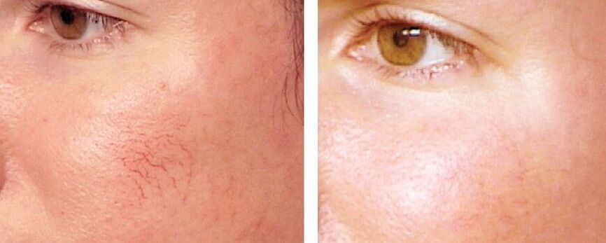 Entfernung von Rosacea