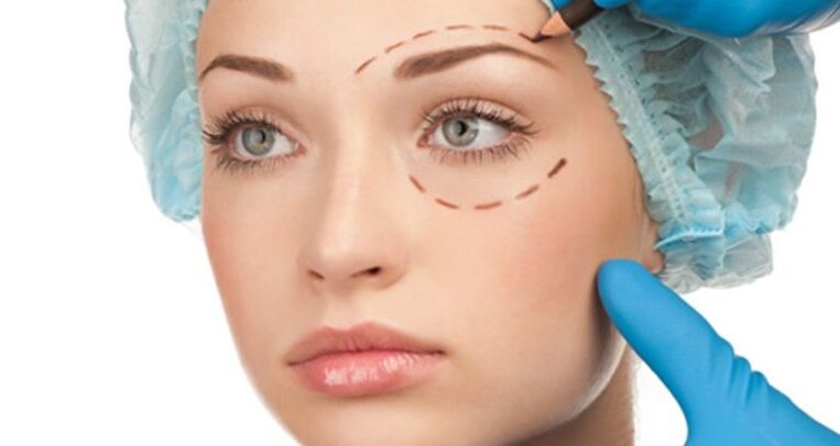 Chirurgisches Facelift