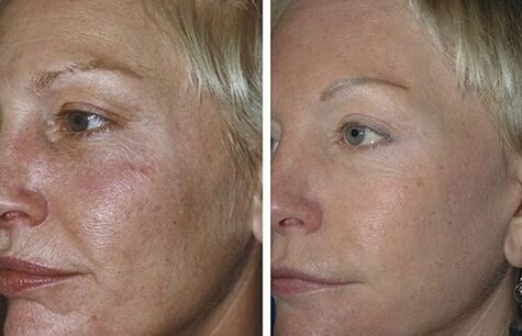 fraktionierte Laserverjüngung vor und nach Fotos