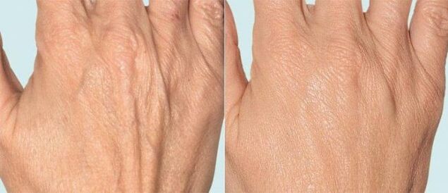 Haut der Hände vor und nach der fraktionierten Therapie