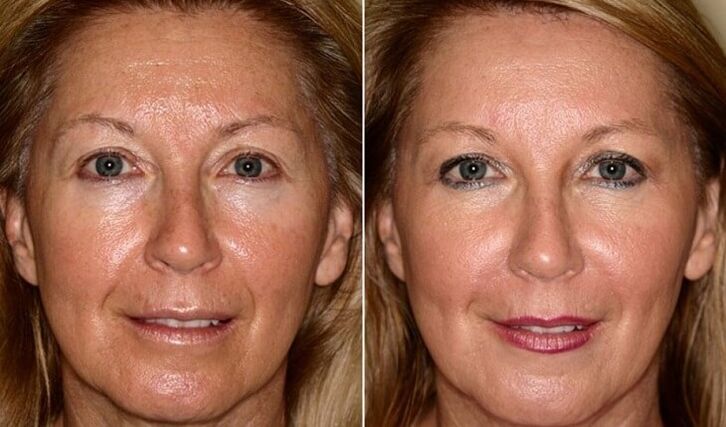 vor und nach der Gesichtshautverjüngung zu Hause
